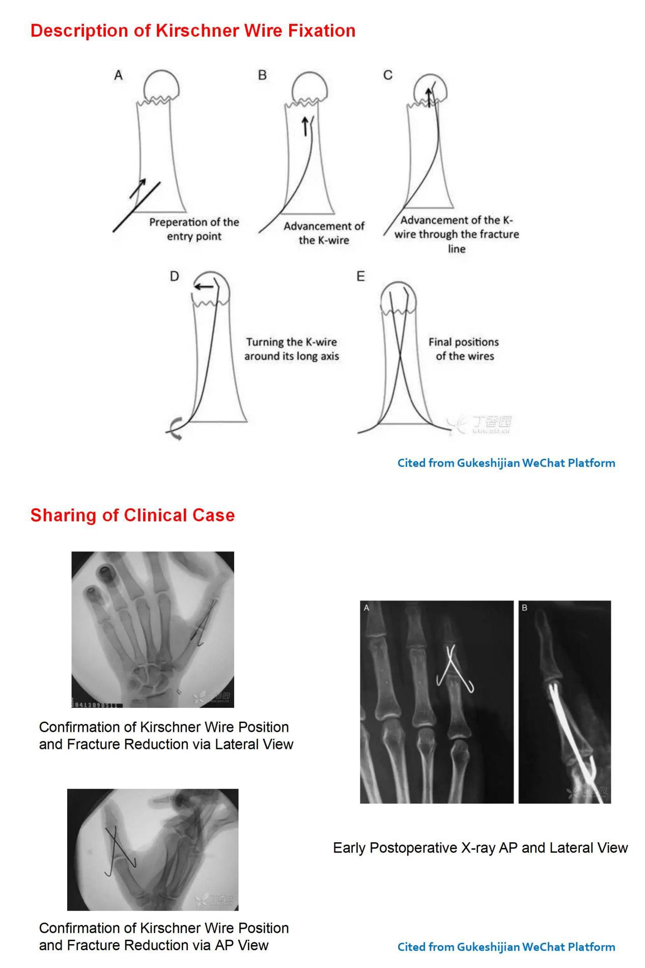 Kirschner Wire Fixation