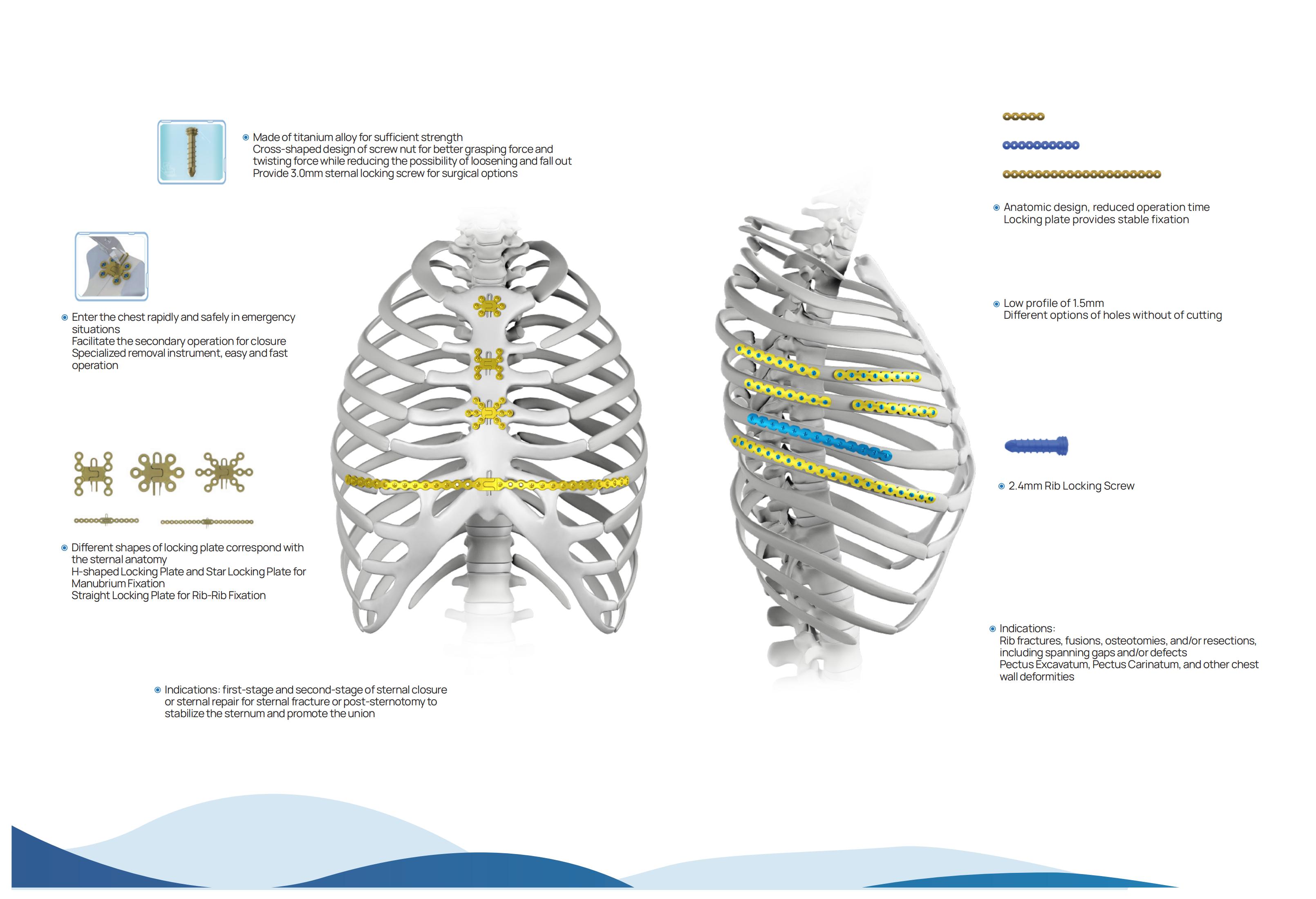 Sternal Fixation System