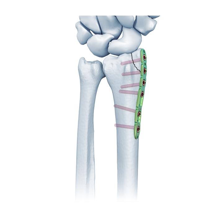 Plaque de compression pour rayon dorsal dorsal à verrouillage à angle variable Va Plaque de compression pour rayon LCP
