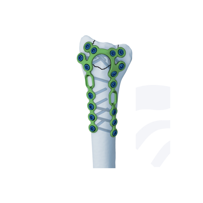 4.0ChLP Dorsal - Plaque Pi radiale Plaque à ossature distale Dorsale 2.5 Plaque osseuse de compression Medartis Radius