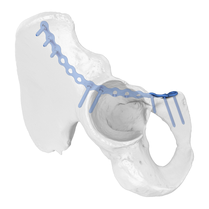 Système de plaque acétabulaire flexible (FAP) Plaque de verrouillage anatomique de la colonne antérieure ilio-pubienne
