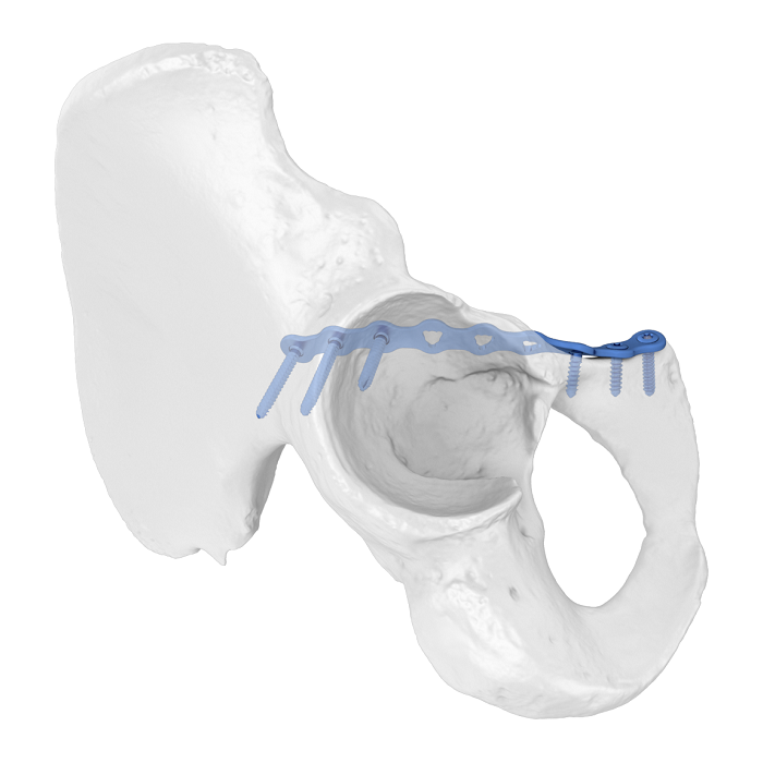 Système de plaque acétabulaire flexible (FAP) Plaque de verrouillage anatomique de la ligne antérieure ilio-pubienne
