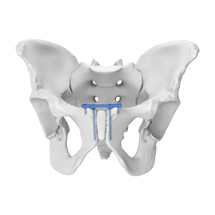 Système de plaque acétabulaire flexible (FAP) Symphyse pubienne Plaque de verrouillage anatomique supérieure
