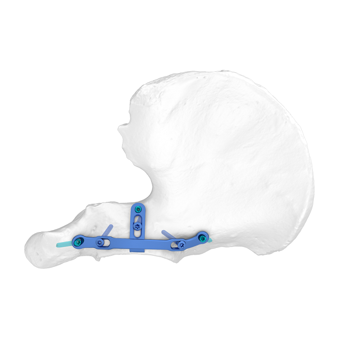 Système de plaque acétabulaire flexible (FAP) Plaque de verrouillage élastique pour paroi postérieure
