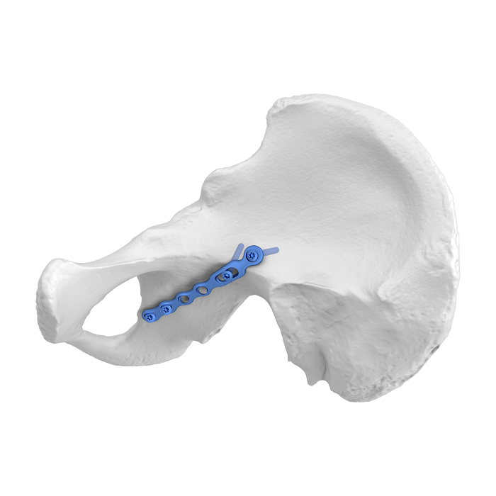 Système de plaque acétabulaire flexible (FAP) Plaque de verrouillage anatomique iliosciatique, oblique
