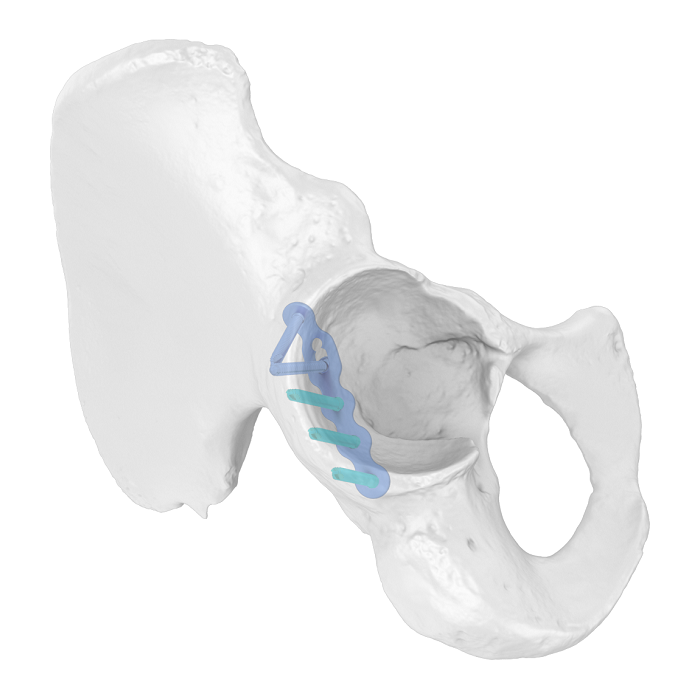 Système de plaque acétabulaire flexible (FAP) Plaque de verrouillage anatomique iliosciatique
