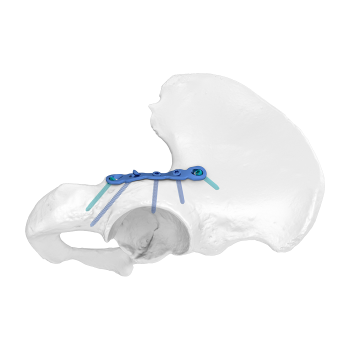 Système de plaque acétabulaire flexible (FAP) Plaque de verrouillage anatomique de la colonne postérieure
