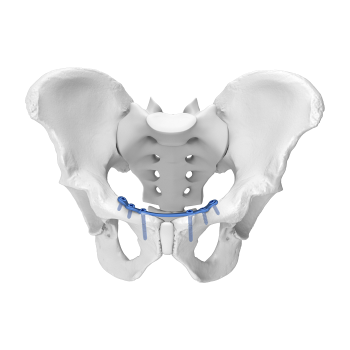 Système de plaque acétabulaire flexible (FAP) Plaque de verrouillage anatomique médiale symphyse pubienne
