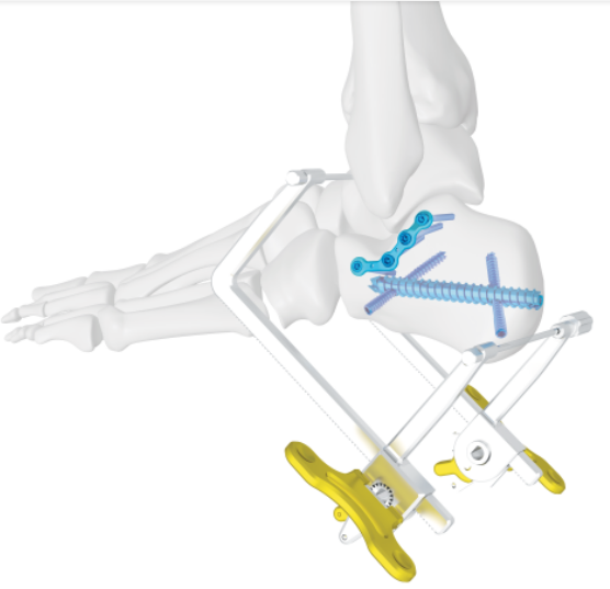 Nouvelle technique chirurgicale des fractures de calcanéus - Double Système de clou de calcanéon médical