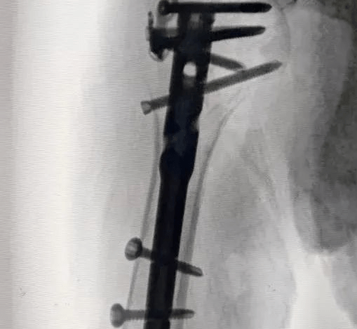 Partage de cas : le premier clou intramédullaire à boule humérale pour fracture humérale proximale en Chine