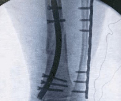 Part de cas : Fracture du tibia distal