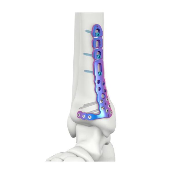 PLATEAU DE VERROUILLAGE TIBIAL MÉDIAL DISTAL