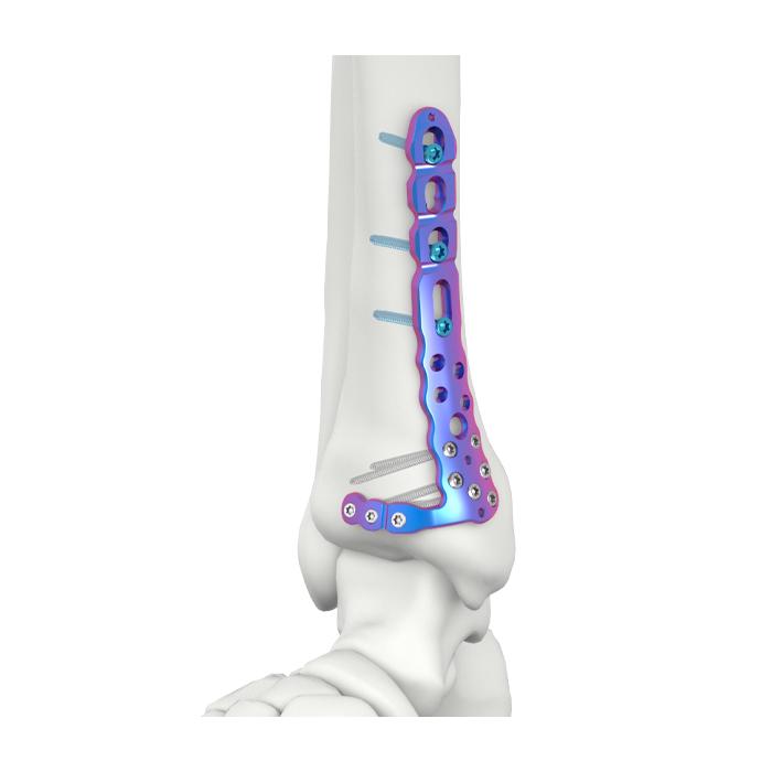 PLATEAU DE VERROUILLAGE TIBIAL MÉDIAL DISTAL