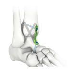 Plaque de verrouillage pour arthrodèse de la cheville MIS