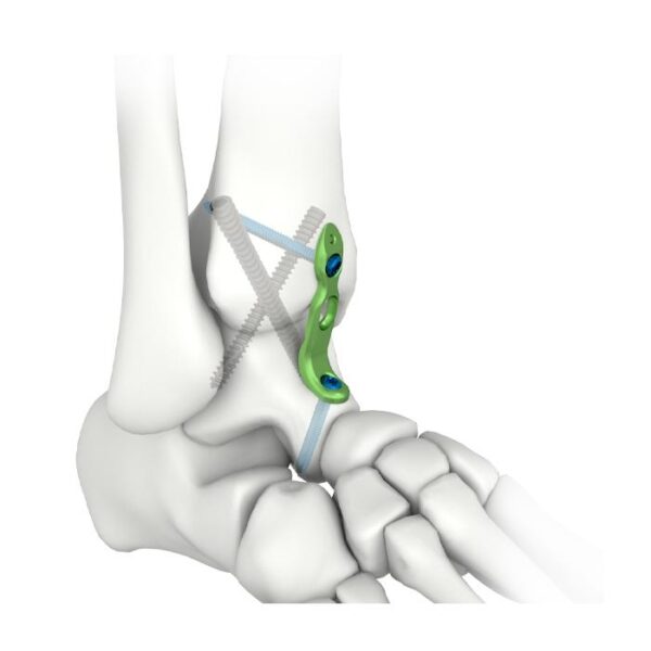 Plaque de verrouillage pour arthrodèse de la cheville MIS