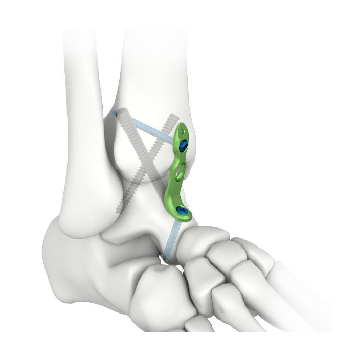 Plaque de verrouillage pour arthrodèse de la cheville MIS