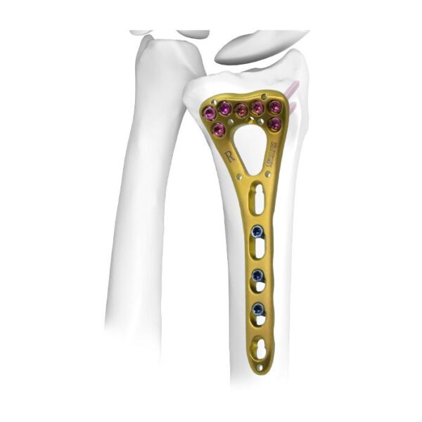 Plaque de verrouillage du radius distal Ⅰ