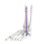 Clou d'arthrodèse de la cheville