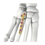 Plaque de verrouillage en forme de T oblique Itval