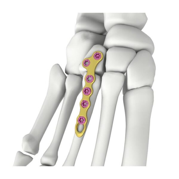 Plaque de verrouillage en forme de T oblique Itval