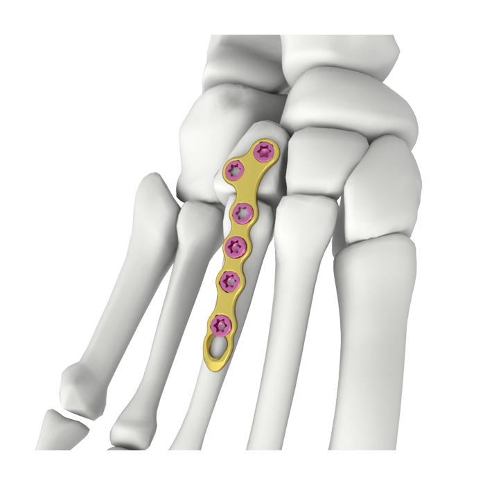 Plaque de verrouillage en forme de T oblique Itval
