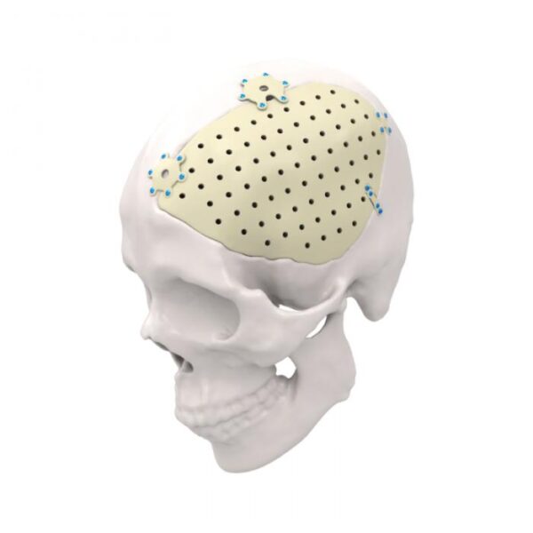 Implant personnalisé spécifique au patient en PEEK et titane pour la réparation et la reconstruction crânienne