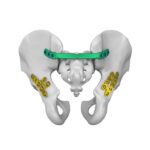 Ces plaques anatomiquement profilées pour l'omoplate constituent un excellent choix pour traiter différents types de fractures de l'omoplate.